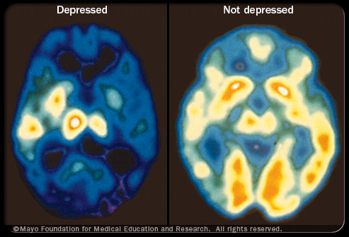 Brain imagery of Depressed and Not Depressed